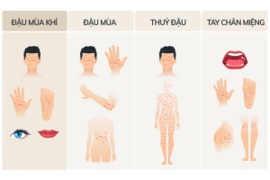  Ca đậu mùa khỉ đầu tiên được ghi nhận ở TPHCM